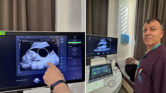 Anne karnındaki bebeğe ‘idrar torbası’ ameliyatı