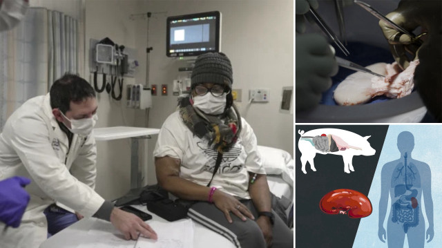 Domuz böbrekli kadın: Bilim adamları bir kez daha başardı