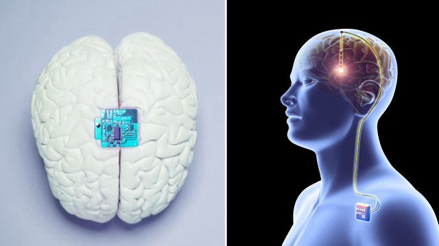 Sessiz tehlike: Beyin implantları bakterilere kapı aralıyor