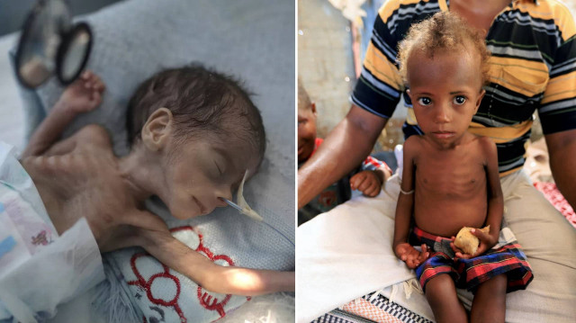 Yemen’de 5 yaş altı her 2 çocuktan biri açlıkla mücadele ediyor