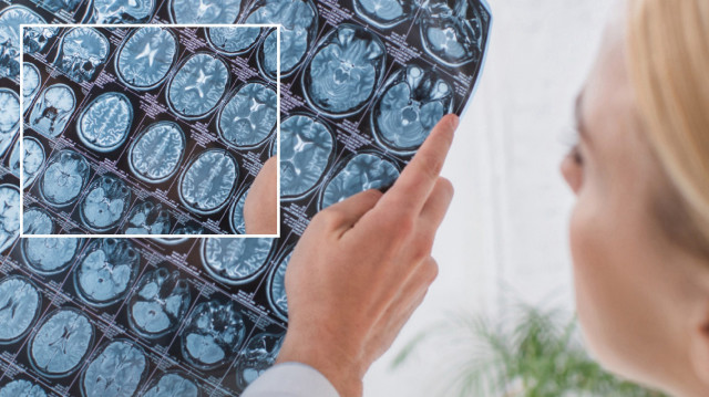 Beyin kanaması geçirdi: Kafatası parçasını midesinde taşıdı