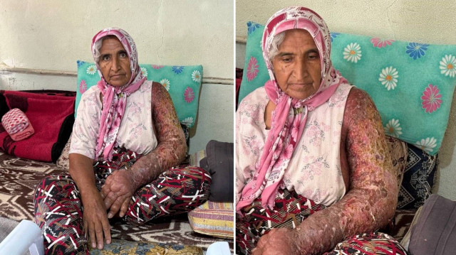 Tıp çare olamadı: Kolu şişen ve vücudunu yaralar saran kadının hayatı kabusa döndü