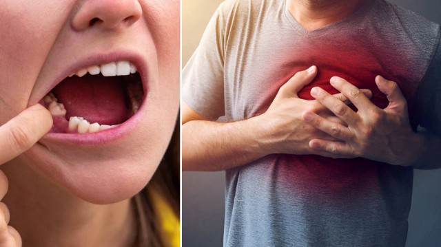 Diş eksikliği kalp krizi riskini nasıl artırıyor?