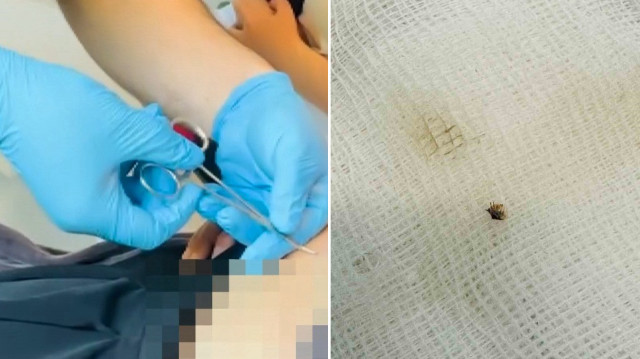Halsizlik yüzünden hastaneye başvuran kadının karnına yapışmış kene bulundu