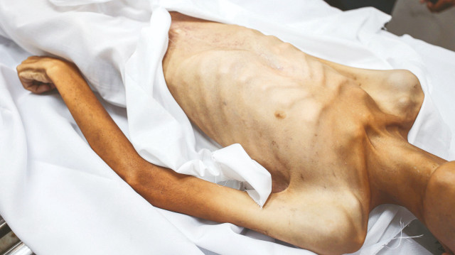 7 kişi daha açlıktan öldü