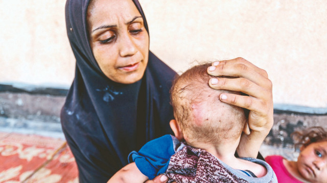 Açlıktan bebeklerin derisi çürüyor