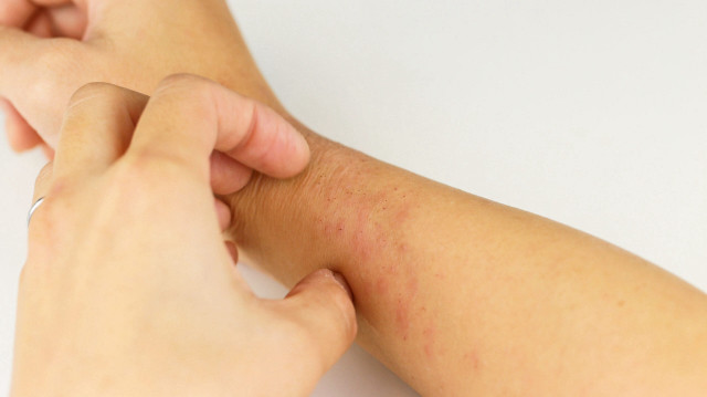 Derideki ağrılı nodüller ‘köpek memesi hastalığı’nın belirtisi olabilir