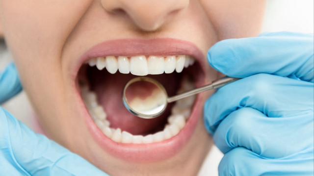 Diş enfeksiyonlarına dikkat: Sepsis gelişebilir