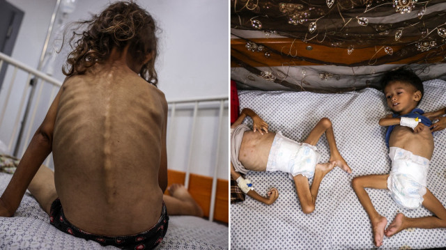 Filistinli 13 yaşındaki çocuk İsrail ablukası nedeniyle açlıktan öldü