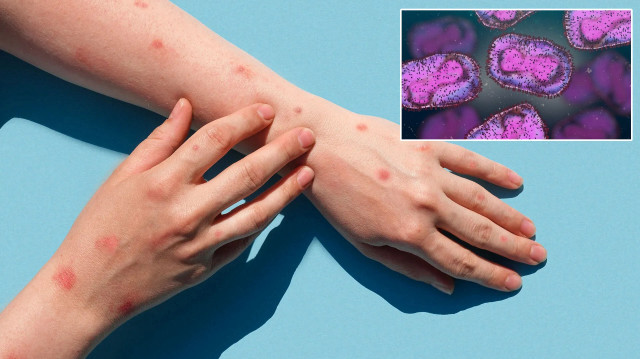 Gana’da M çiçeği virüsü kaynaklı ilk ölüm