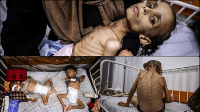 Kitlesel açlığın yaşandığı Gazze’deki doktor: Böyle şeyleri kitaplarda okurduk şimdi birebir şahit oluyoruz