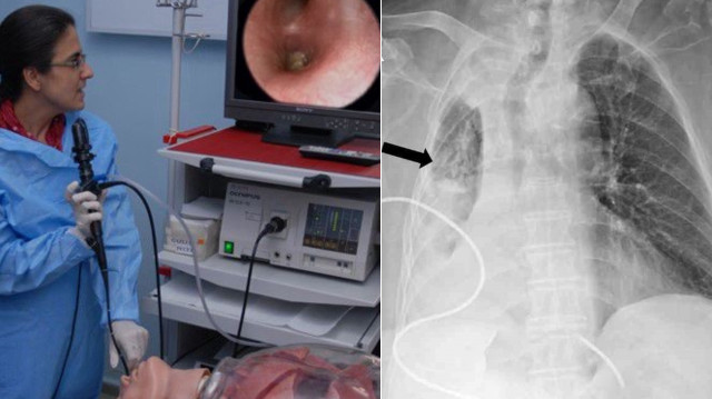 Nefes borusuna mısır kaçtığı 5 ay sonra ortaya çıktı