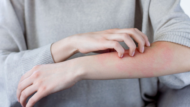 Uzmanı açıkladı: O belirtiler ‘uyuz’ habercisi olabilir