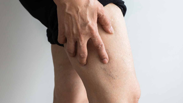 Uzmanından kritik uyarı: Yaz aylarında artan varis şikayetleri ihmal edilmemeli