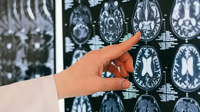 Beyin sisi günlük yaşamı ve iş hayatını olumsuz etkileyebiliyor