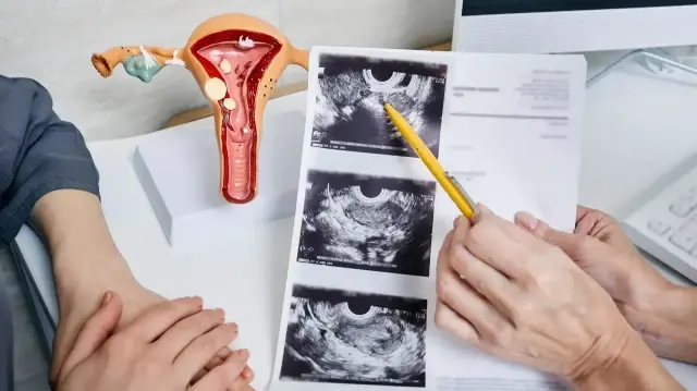 Polikistik over sendromlu kadınlarda zaman algısı araştırıldı