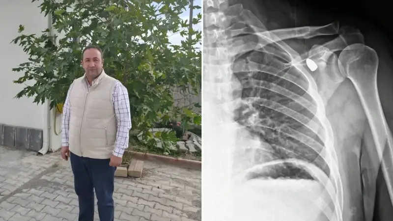 6 yıl boyunca vücudunda taşıdı: Ameliyatla çıkarıldı