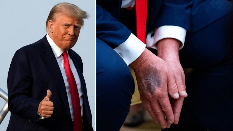 ABD Başkanı Trump elindeki morlukların sebebini açıkladı: ‘Batıl inançlara sahibim’