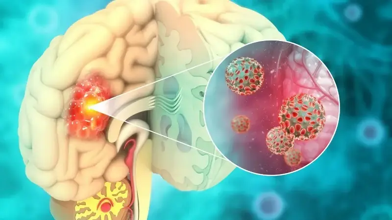 Beyin tümörlerinde baş ağrısı ve kusma kritik uyarı işareti olabilir