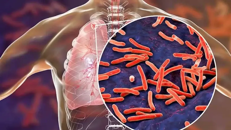 Sessiz salgın: 2024’te 1,2 milyondan fazla kişi tüberkülozdan öldü