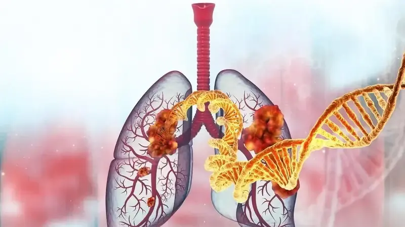 Türk bilim insanları akciğer kanserinde radyoterapiye yanıtı belirleyen 12 gen tespit etti
