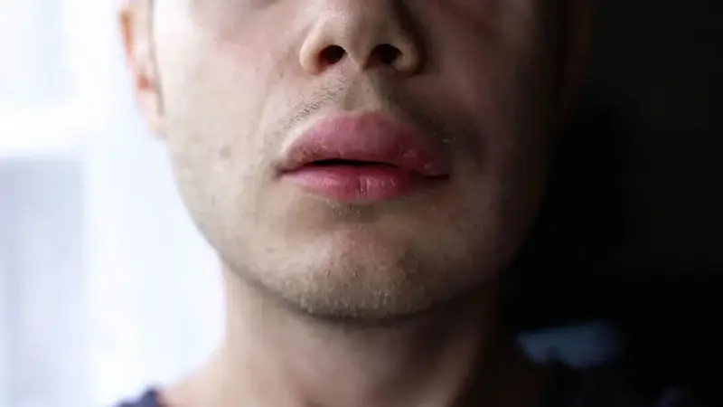 Nadir görülen herediter anjioödem hastalığı tedavi edilmezse ölümcül olabilir