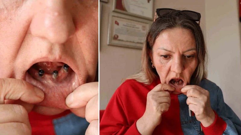 Diş ağrısı şikayetiyle hastaneye gitti, implant çetesinin eline düştü: 36 çeyrek altın harcadı, 25 dişinden birden oldu