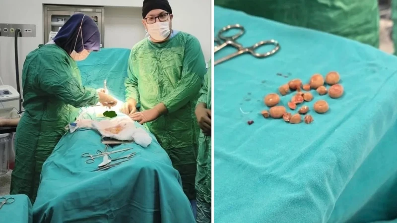 İki hastanın mesanesinden 27 taş çıkarıldı